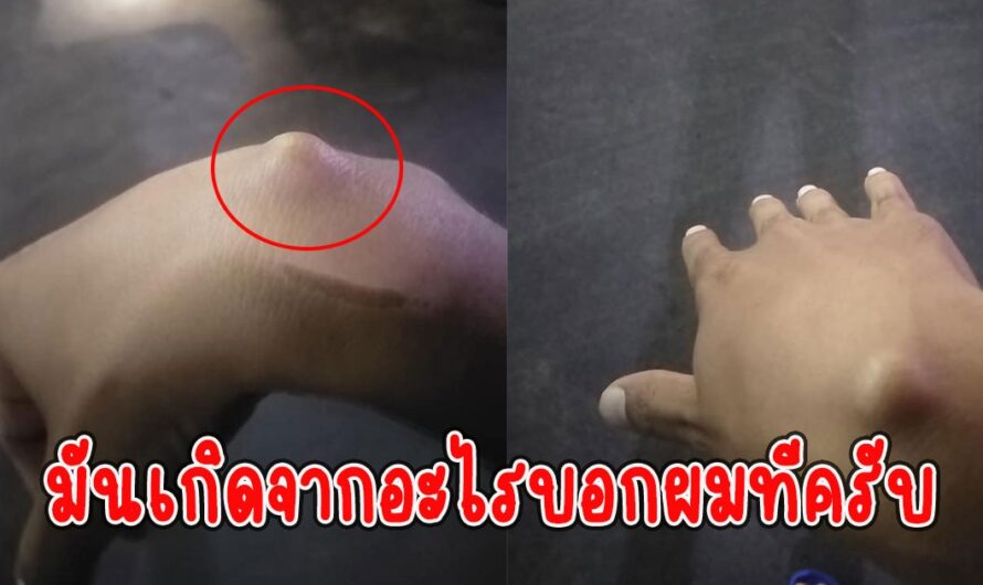 หนุ่มสงสัยรีบถามโซเชียล อยู่ๆข้อมือมีตุ่มขึ้น จับแล้วไม่ค่อยเจ็บ